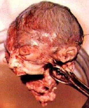 Aborted Baby's Head Photo