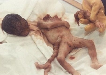 Aborted Baby Photo